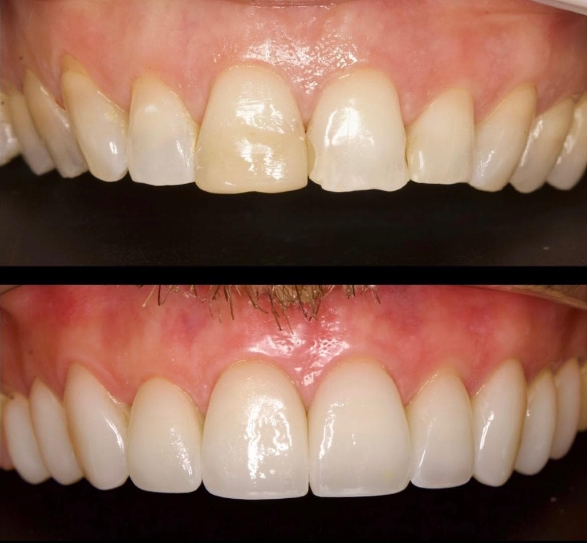 Transformação 2 — facetas dentárias
