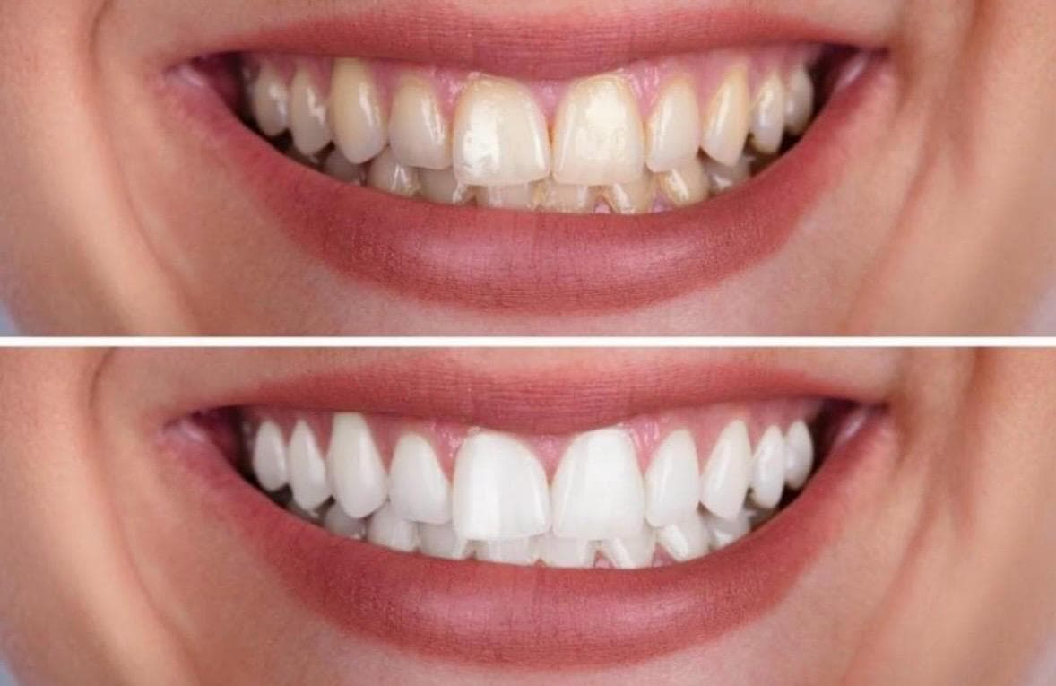 Transformação 3 — facetas em porcelana