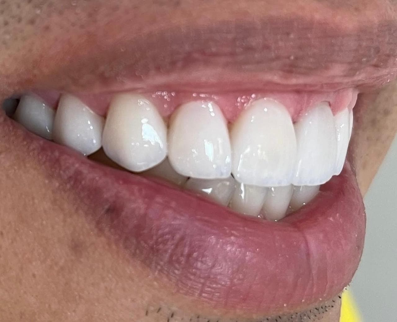 Transformação 7 — reabilitação