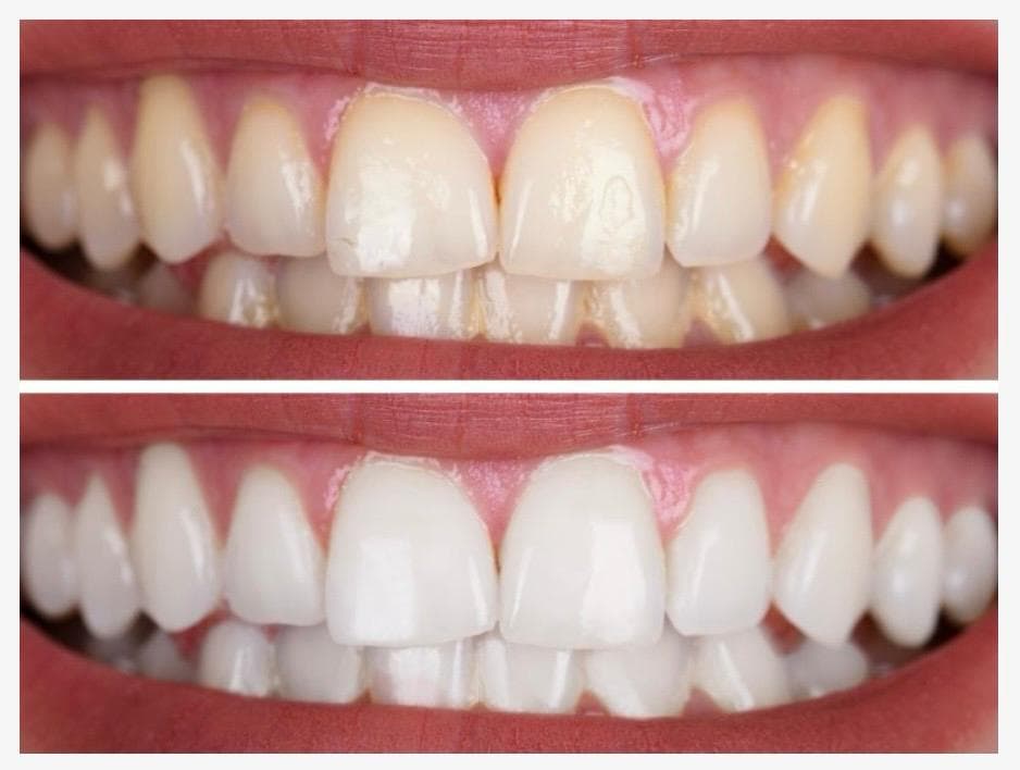 Clareamento dental
