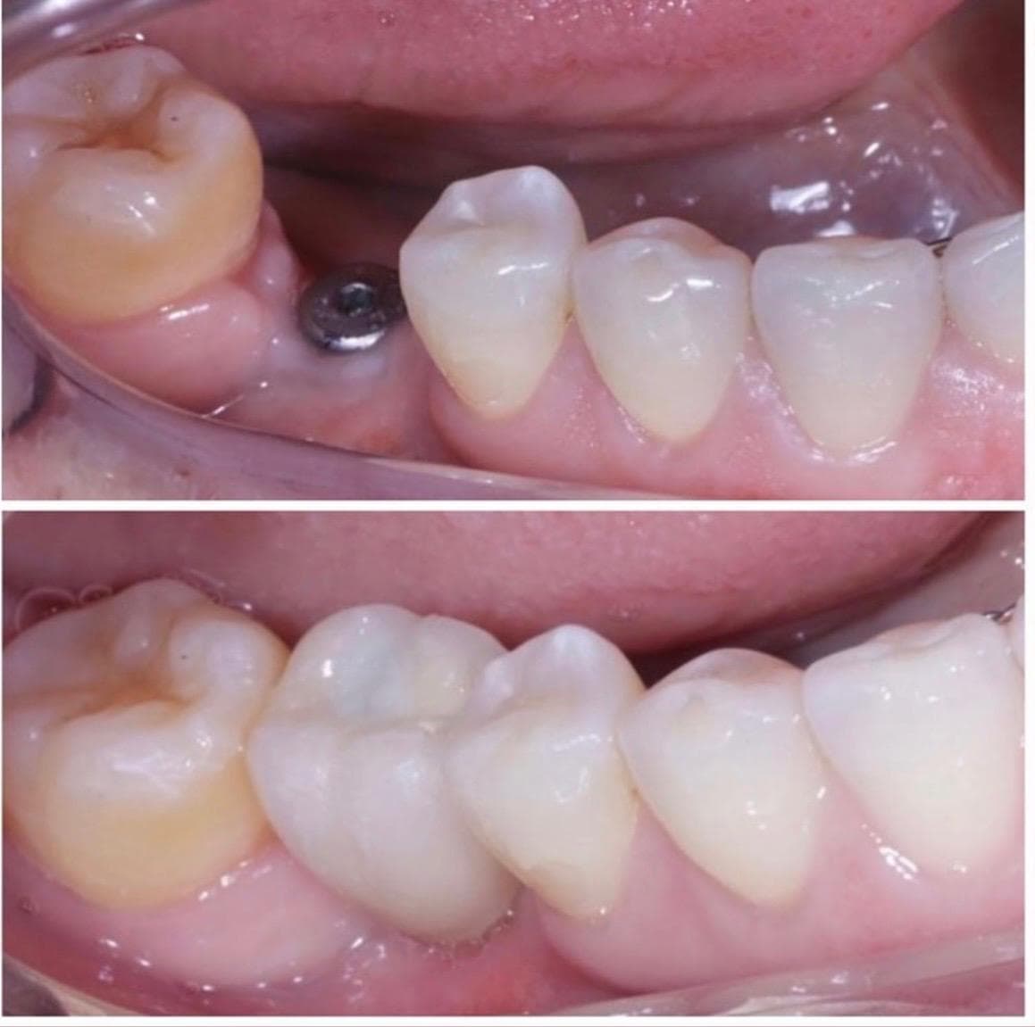 Implantes dentários — caso clínico