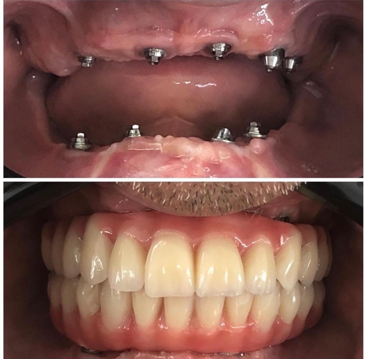 Prótese protocolo sobre implantes